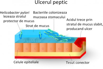 Infectia Digestiva Cu Helicobacter Pylori